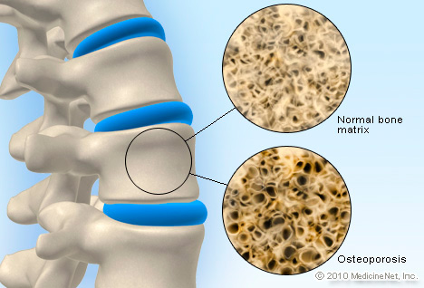 detail_osteoporosis